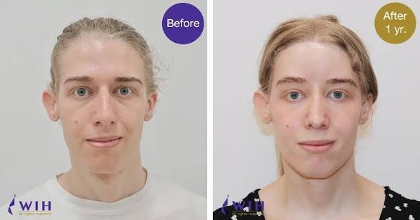 Recovery After Facial Feminization in Thailand