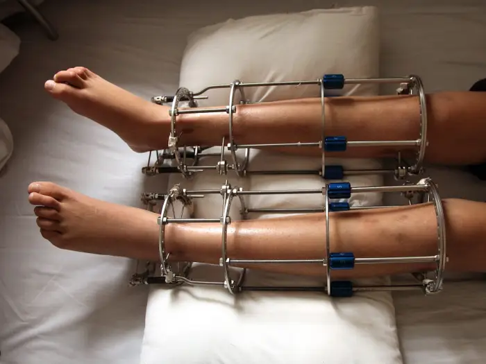 The Real Risks of Leg Lengthening, in the Order They Actually Happen