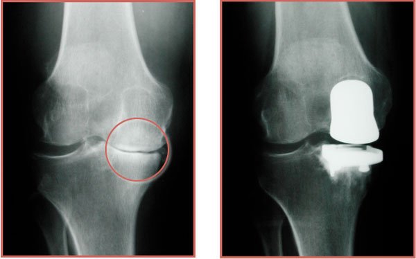 Partial or Total Knee Replacement Your Knee Answers Most of It